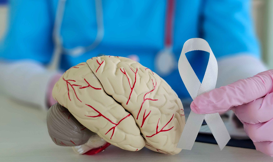 Stroke Hemoragik: Kenali Penyebab, Gejala, dan Pencegahannya Menurut Dokter Spesialis Saraf RS Sari Asih Ciputat
